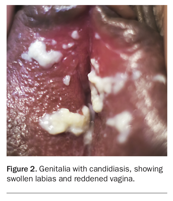 Vulvovaginal Candidiasis Discharge